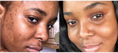 Does Turmeric Soap Remove Dark Spots? | OEM & Benefits